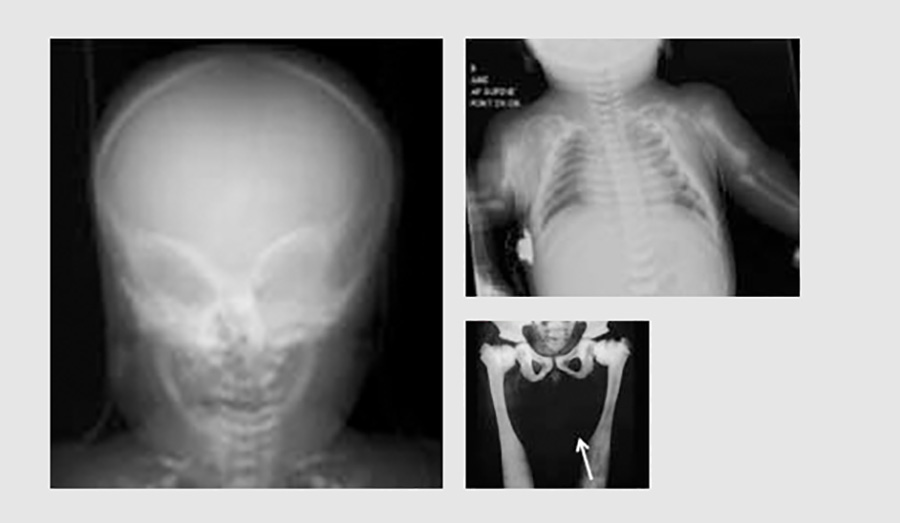 X-ray images of abnormal bone development caused by severe malignant osteopetrosis (SMO)